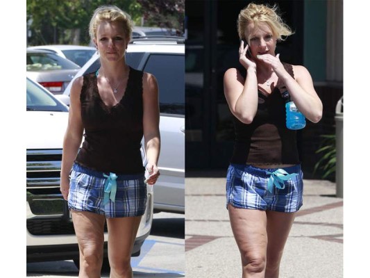 La princesa del pop Britney Spears, después de haber tenido uno de los cuerpos más deseados del mundo, la cantante sufrió de depresión lo que alteró su alimentación subiendo de peso y se reflejó en sus piernas.