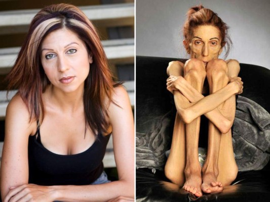 10 famosas que padecen anorexia