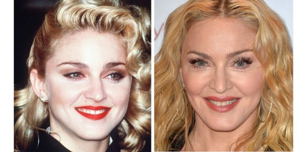 Madonna. sin duda alguna, Madonna ha demostrado en la última década que más allá de ser la reina del pop es la 'reina de las cirugías plásticas”. La interprete a sus 56 años ha cambiado radicalmente su rostro, comenzando con colocarse implantes de pómulos, aumento de labios y realizarse un lifting facial