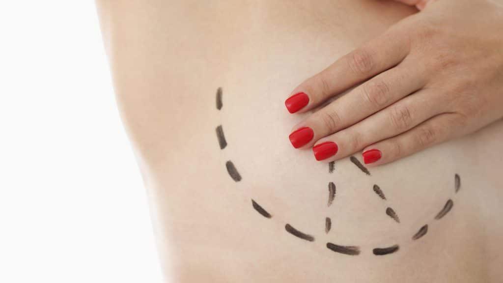 La cirugía reconstructiva después de una mastectomía: Opciones y consideraciones