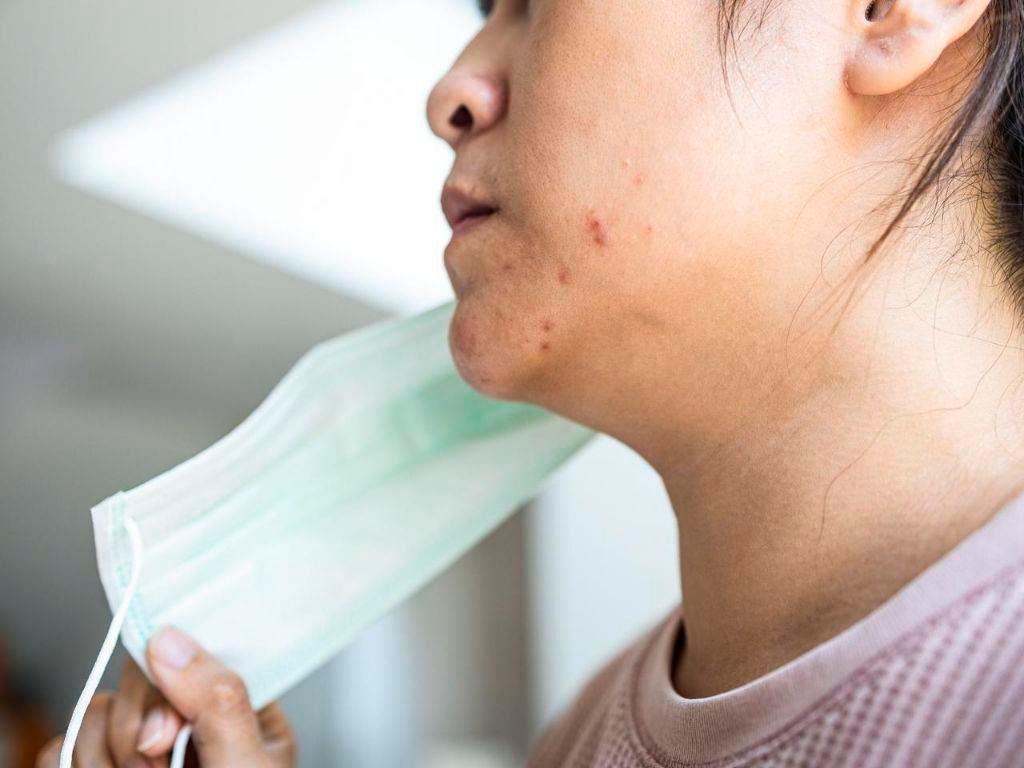 El uso diario de mascarillas puede provocar acné