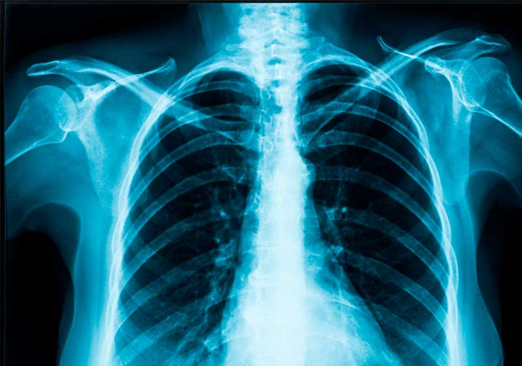 3. Colaboración en red A.Catalyst con apoyo de Lung Ambition Alliance implementó inteligencia artificial en radiografías de tórax, identificando precozmente riesgo de cáncer pulmonar, beneficiando a más 12,000 pacientes en menos de 1 año.