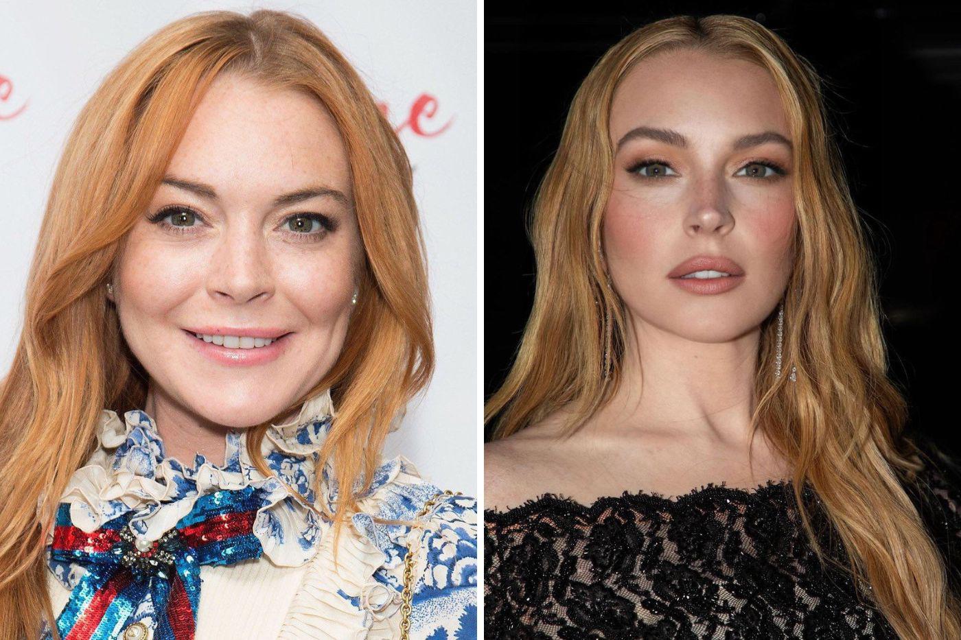 Lindsay Lohan, sorprendió a todos al reaparecer luciendo totalmente diferente, la actriz recurrió a tratamientos estéticos leves para mantener una apariencia más juvenil, sometiéndose al uso de botox y rellenos faciales para suavizar las líneas de expresión, también se ha realizado procedimiento láser, peelings y también ha mantenido una rutina saludable para el cuidado de su piel. 