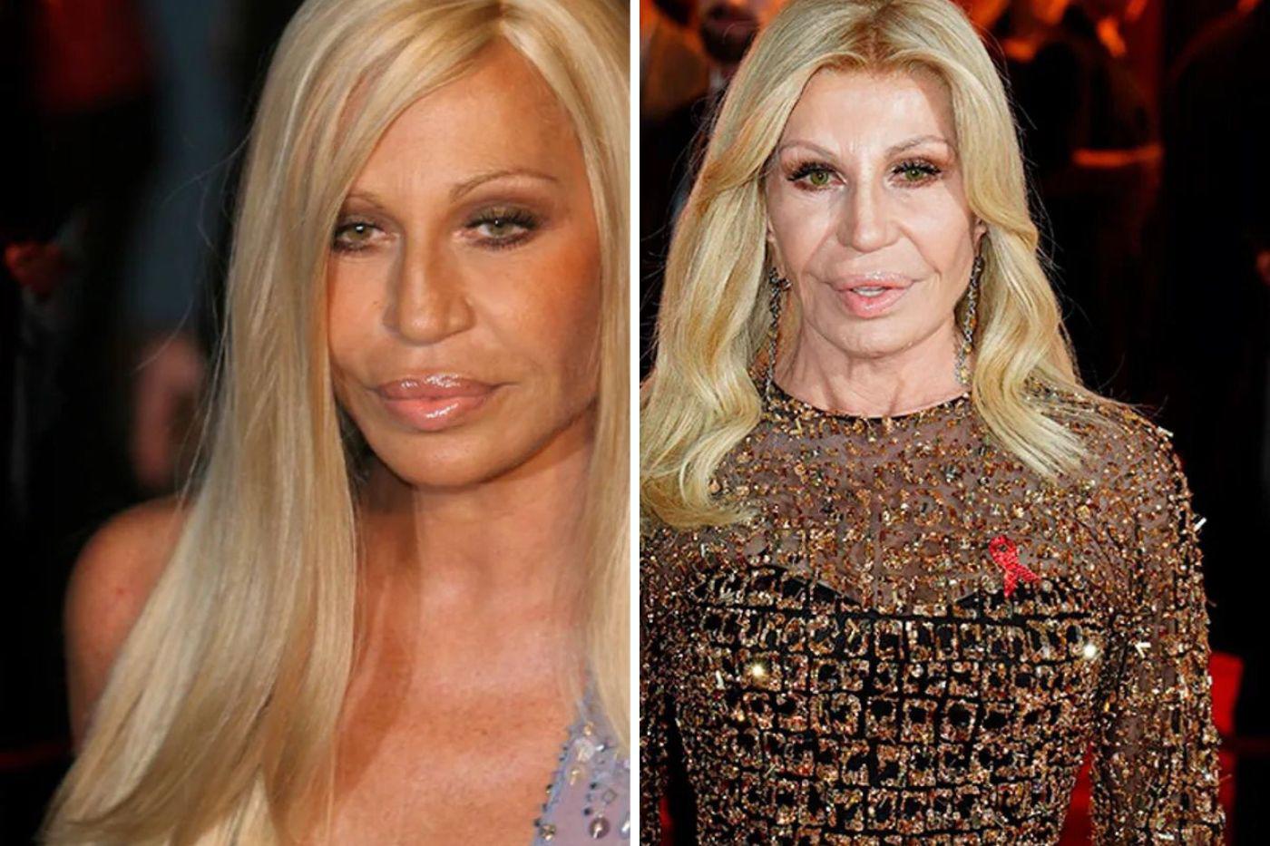 Donatella Versace, ha experimentado una transformación estética bastante notable, lo cual ha dado mucho de que hablar. Se ha sometido al uso de botox, lifting facial, rellenos dérmicos, un aumento en los labios y peelings químicos. A pesar de la opinión pública, la empresaria ha enfatizado la importancia de sentirse bien consigo misma.