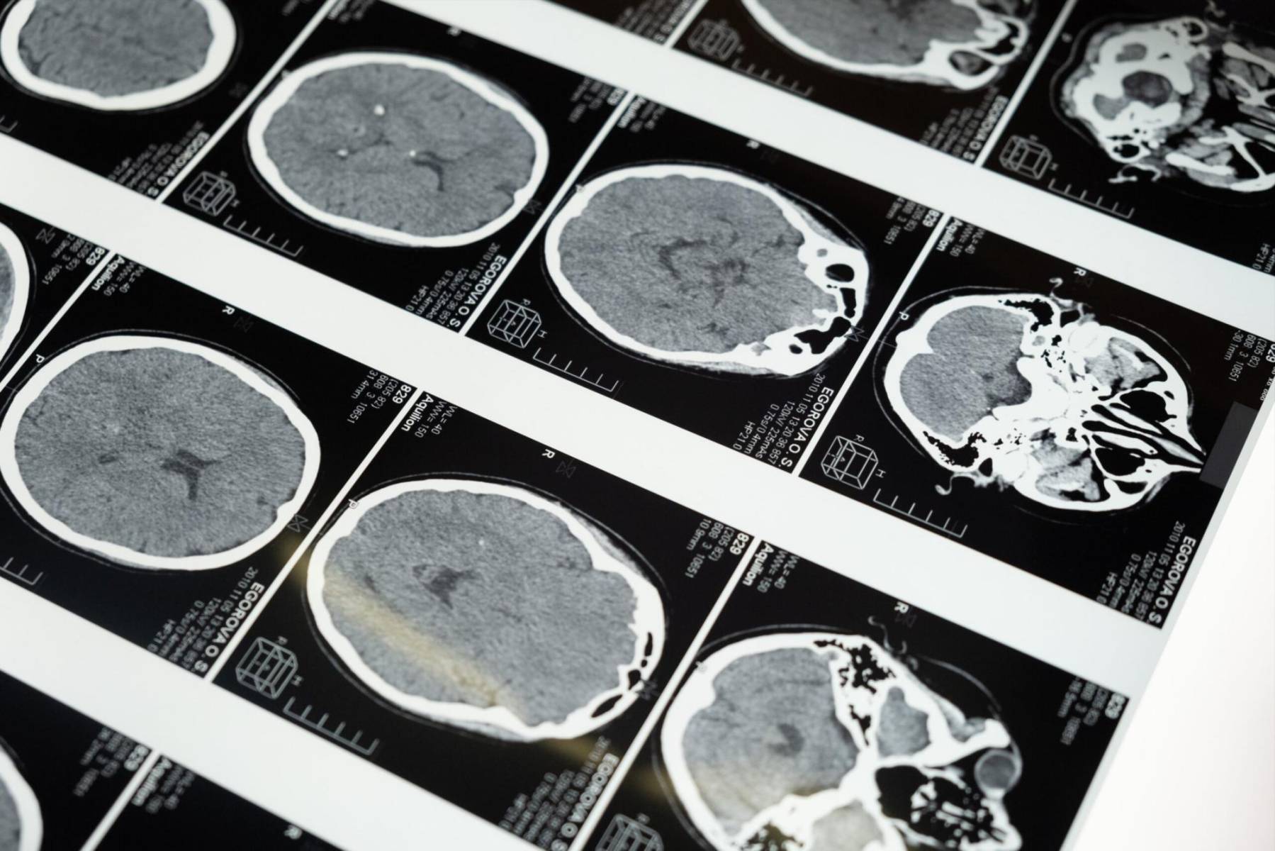 La demencia frontotemporal es causada por un conjunto de trastornos que poco a poco perjudican los lóbulos frontal y temporal del cerebro, lo que provoca alteraciones en la conducta y el pensamiento de la persona que lo padece. Es una enfermedad progresiva, lo que significa que los síntomas empeoran con el tiempo.
