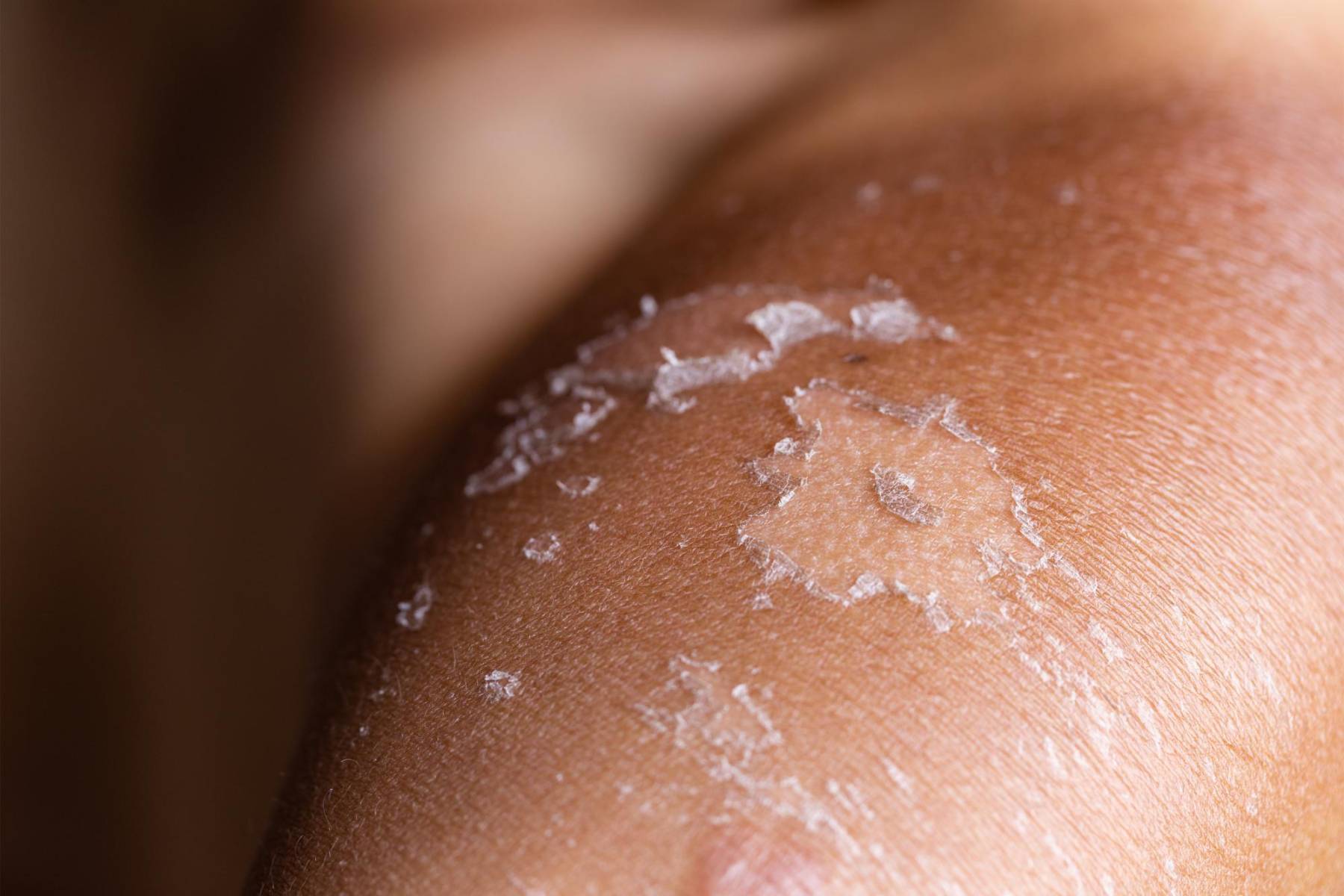 <b>No peles tu piel</b>¡Aunque sea tentador! Si tu piel comienza a pelarse, déjala. No arranques ni frotes, porque podrías generar cicatrices o infecciones. Mejor sigue hidratando y deja que el proceso natural siga su curso.