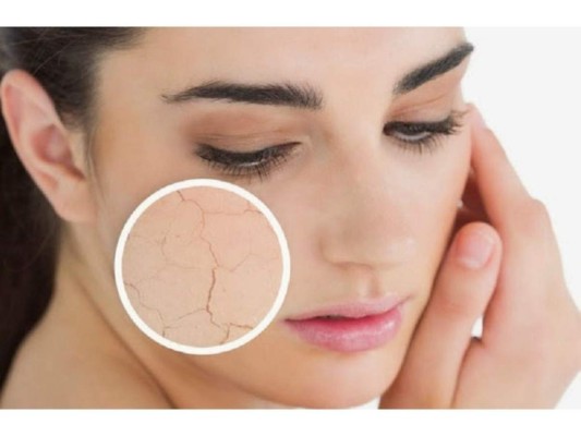 Piel seca: La piel seca se debe a la exposición al clima frío o muy caliente, así como también por los constantes baños con agua a una alta temperatura, por lo que debes procurar tratar la forma de mantenerla muy humectada.