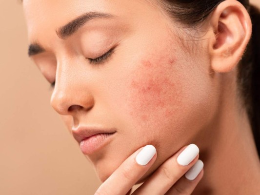 ¿Qué produce el acné y cómo quitar sus manchas?