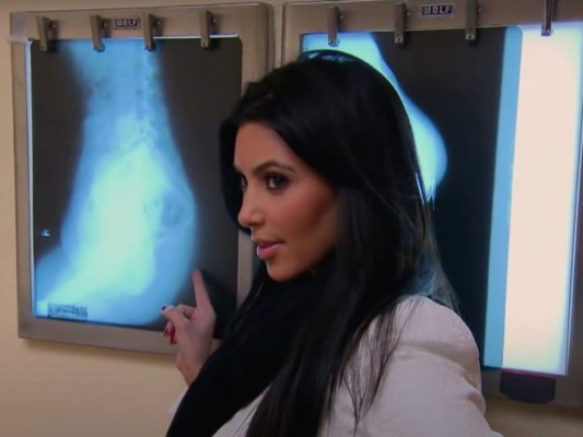 Radiografía del trasero<br/>Kim se sometió a una radiografía de trasero en 2011 para demostrar a los escépticos que su trasero es real. Harta de los rumores de cirugía plástica, dijo: 'He dicho muchas veces: 'No me he sometido a una cirugía plástica, no me he hecho implantes de glúteos''.<br/>