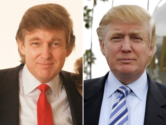 Donald Trump, dueño de un corte de pelo un tanto “jovial” para su edad, se resiste ha envejecer y ha gastado parte de su fortuna en las salas de los hospitales donde le han hecho cirugías, aplicado botox e incluso implantes de cabello.