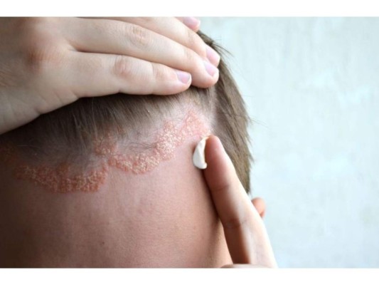 Dermatitis.