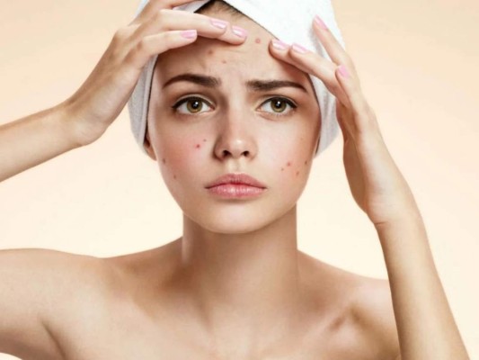 ¿Cuáles pueden ser las causas del acné en adultos?