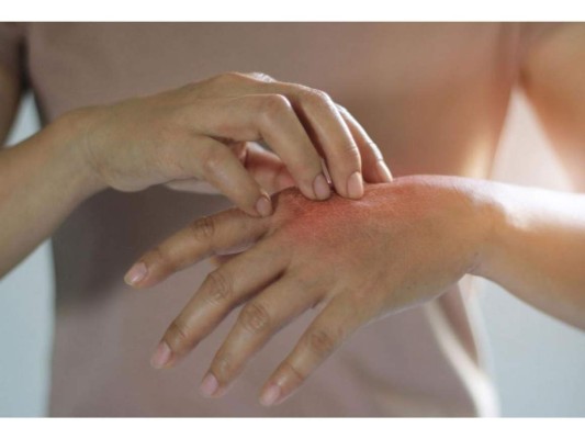 Protege la piel con rosácea y psoriasis.