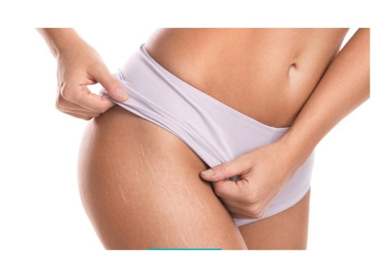 Se acerca el verano y es hora de lucir un hermoso traje de baño; si te acomplejas por tus estrías, no te preocupes, aún estás a tiempo para eliminarlas de tu cuerpo con estos simples remedios que te compartiremos. ¡Manos a la obra!