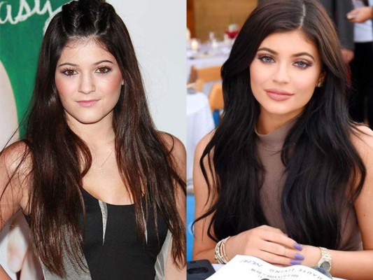 Kylie es una de las que más cambió, se dice que se ha sometido a cirugías desde temprano, ella solo confesó tener rellenos labiales.