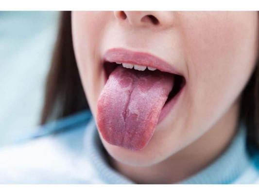 Lengua geográfica: La lengua geográfica suele presentar manchas rojas, lisas e irregulares puede llegar a causar dolor, ardor e incomodidad. Para este caso debes asistir al dentista para que te recete el tratamiento indicado.