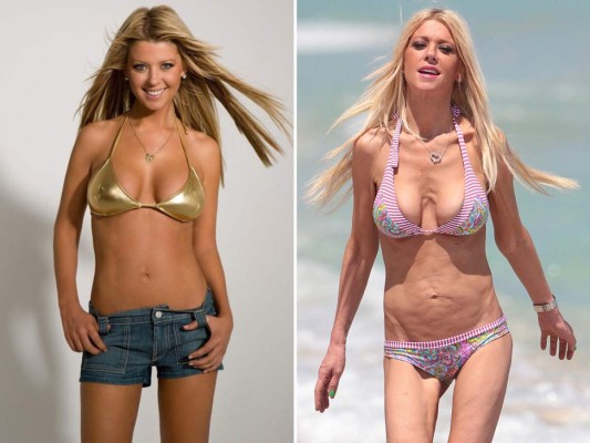 10 famosas que padecen anorexia