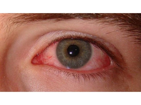 Conjuntivitis.