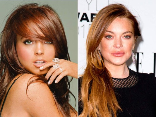 Lindsay Lohan. La atractiva joven que actuó en Chicas Pesadas hoy (aparentemente) es una adicta a las cirugías y al botox. Desde su evidente adicción por las drogas, su vida de juerga, sin mencionar claro, la relación lésbica que mantuvo durante un largo tiempo. El problema de la actriz no son las noches de alcohol y drogas, sino la horrorosa y desfavorable transformación que ella realizó en su rostro.