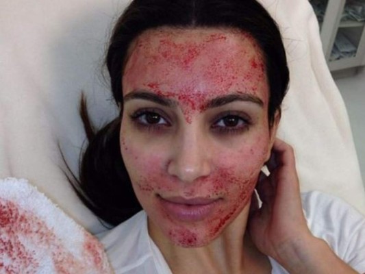 Resucitando el facial vampiro<br/>Cuando Kim Kardashian publicó una foto de su rostro cubierto de sangre en 2013, la reacción inicial de la mayoría de la gente fue de sorpresa.<br/>