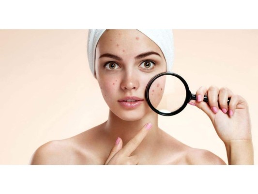 Tratamiento contra el acné<br/>Es un elemento importante para tratar de manera natural todo tipo de acné. Además es usado para exfoliar la piel.<br/>