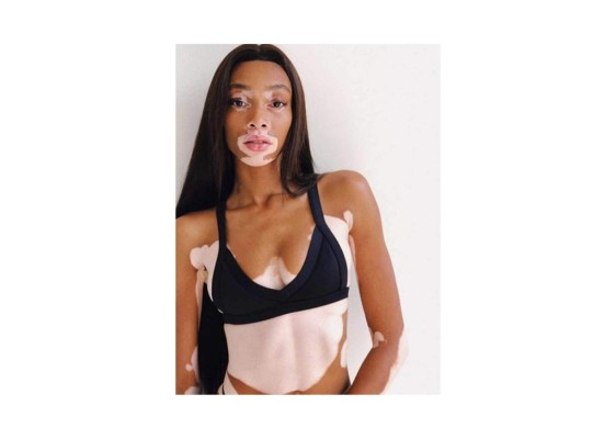 Su verdadero nombre es Chantelle Brown-Young, pero su nombre artístico es Winnie Harlow.