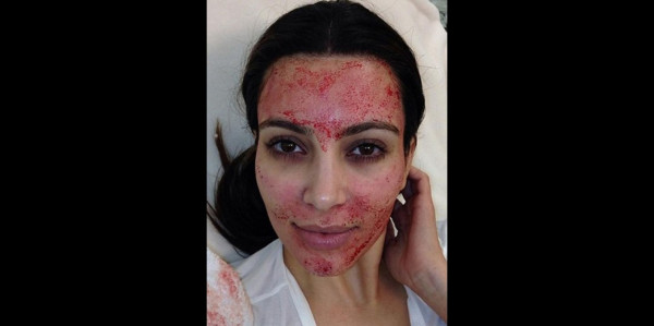 Kim Kardashian se somete al 'facial vampiro'