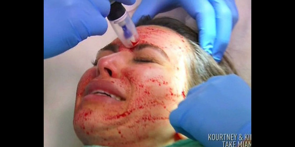 Kim Kardashian se somete al 'facial vampiro'
