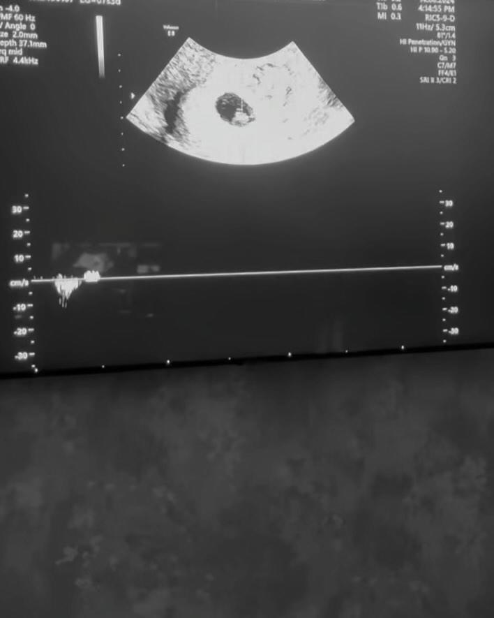 Pese a la inmensa alegría y las expectativas, el bebé, Thiago, no pudo llegar a término. Esta pérdida fue un golpe devastador para Antonia y su pareja, quienes habían estado esperando con ansias el momento de tener a su hijo en brazos.