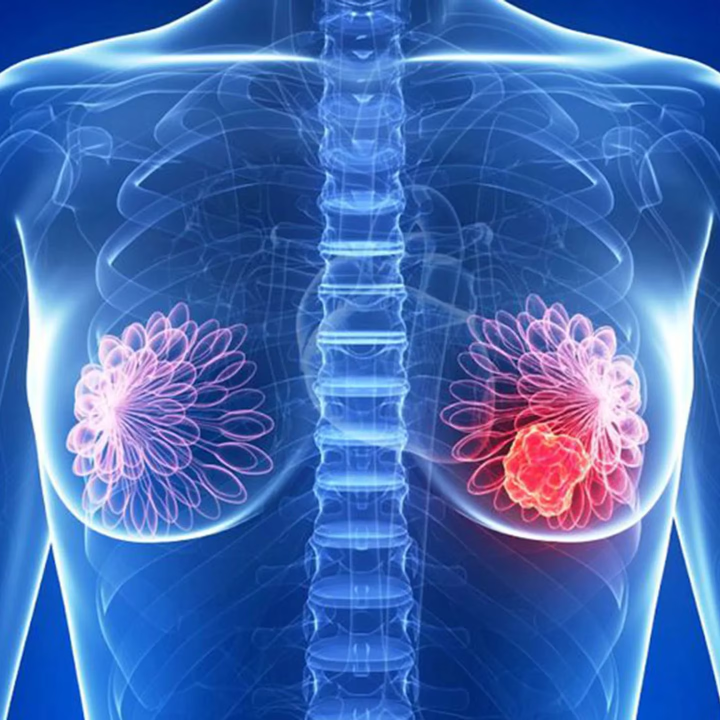5. Solución para cáncer de mama: Estrategia terapéutica digital para EPI. Este enfoque integral se centra en pacientes en etapa 1 y busca recopilar datos para comprender la EPI, una afección pulmonar. Se emplea un dispositivo de oximetría de pulso y una aplicación de seguimiento con una escala de resultados del paciente. Se realizan entrevistas cualitativas al final del estudio. El objetivo es identificar signos tempranos de EPI en pacientes de cáncer de mama para mejorar la detección y manejo de esta afección.