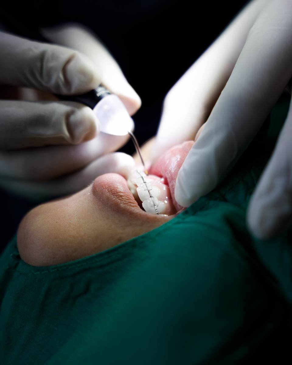 <b>Implantes: </b>un implante dental es una raíz artificial que se inserta dentro del hueso, muchas personas usan el término “implante dental” para referirse a todo el diente, pero este concepto solo se refiere a la parte que va insertada dentro del hueso.